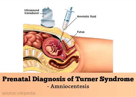 Turner Syndrome Causes Types Symptoms Diagnosis Treatment