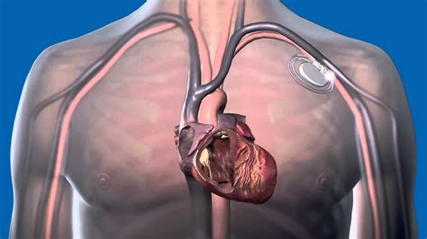 What Is A Pacemaker And How Does It Work Youtube