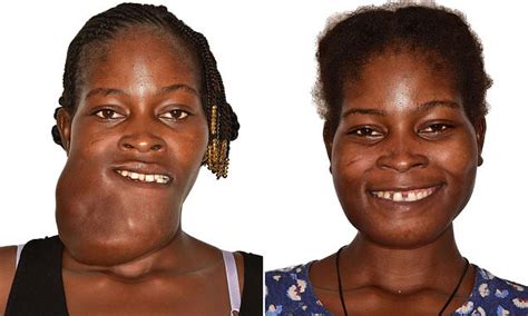 Woman 23 Stoned By African Villagers Has Giant Facial Tumour Removed