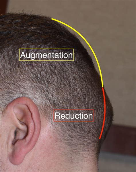 Occipital Skull Contouring With Knob Reduction And Upper Augmetation Dr
