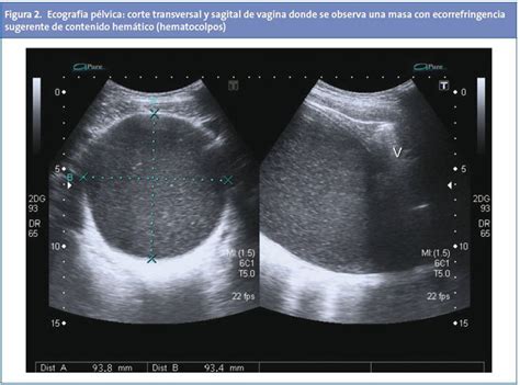 Hematocolpos Secundario A Himen Imperforado Causa Infrecuente De Masa