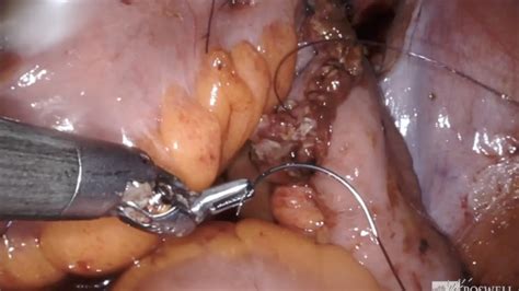 Day 1 Robot Assisted Radical Cystoprostatectomy With Bilateral Lymph
