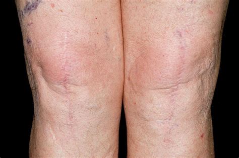 Total Knee Replacement Scars Photograph By Dr P Marazziscience Photo Library