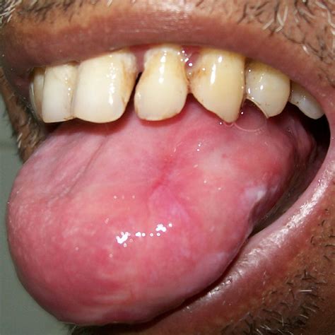 Preoperative Photograph Of A Patient With Leukoplakia Over The Left