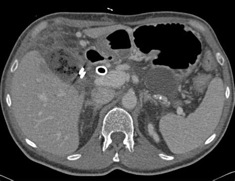 Abscess In The Gallbladder Fossa Liver Case Studies Ctisus Ct Scanning