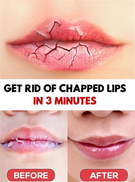 How To Get Rid Of Chapped Lips With These Diy Lip Scrubs Dry Lips