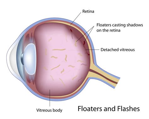 Eye Vitreous Floaters Petrou Eye Care