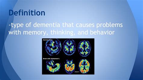 Alzheimers Disease Presentation