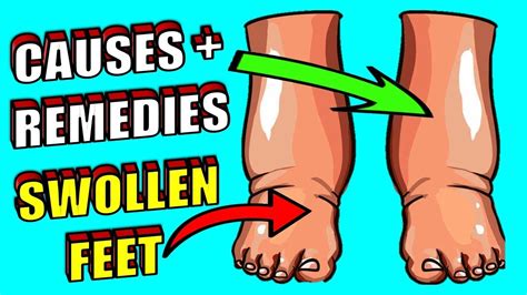 Swollen Feet Cause And Home Remedies For Swollen Feet Youtube