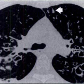 Year Old Man With Cystic Fibrosis A Initial Ct Scan Obtained At Level