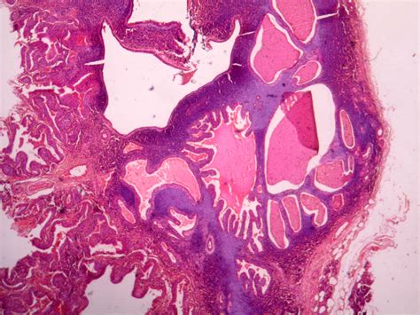 Warthins Tumor Histopathologyguru