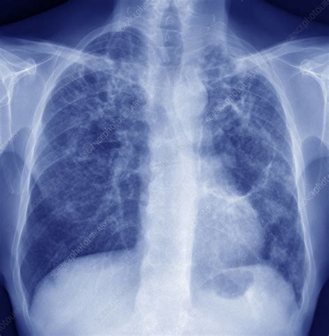 Tuberculosis X Ray Stock Image C0402217 Science Photo Library