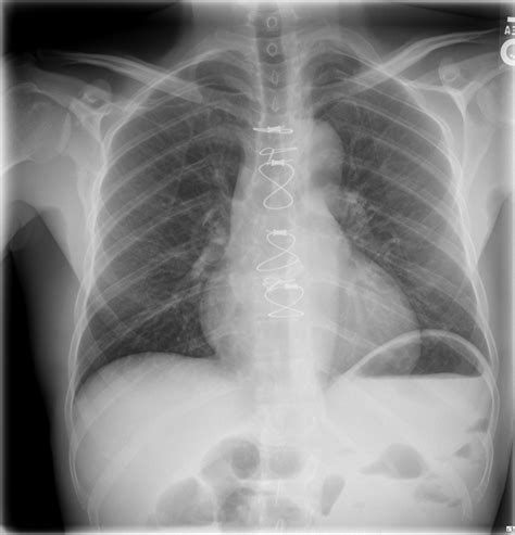 Ap Chest Xray With Aortic Valve Replacement Clinical Grepmed
