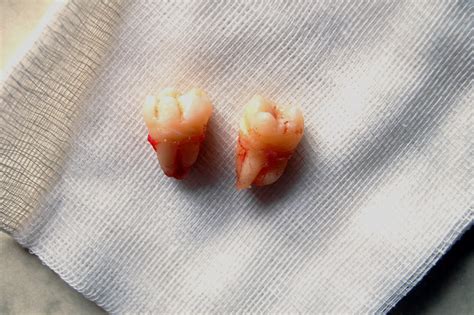 Filewisdom Teeth 2 Wikimedia Commons