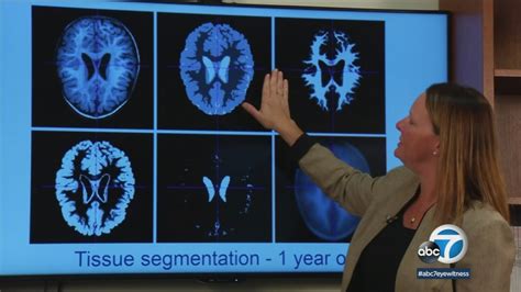 Baby brain study pinpoints early signs of autism - ABC7 Los Angeles