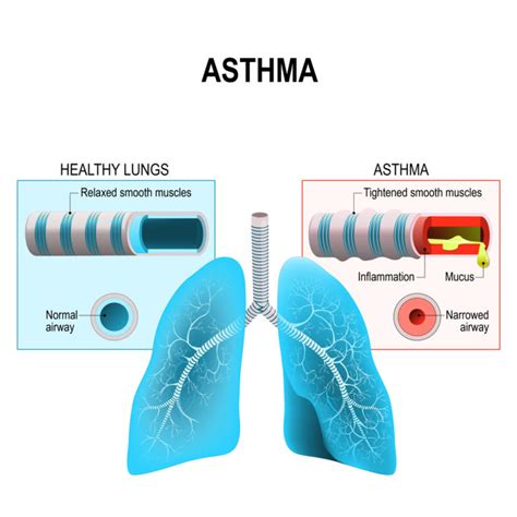 Relationship Of Asthma And Allergies Colorado Allergy And Asthma