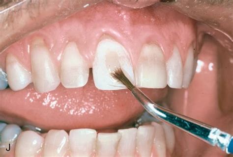 Composite Resin Indirect Technique Restorations Pocket Dentistry