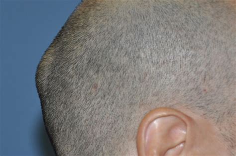 Lump On Back Of Head Learn Most Common Reason Of Bump On Back Of Head