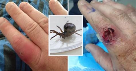 False Widow Spider Bite Nearly Cost Joiner His Finger As He Watched