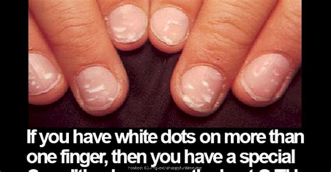 Those White Dots On Your Fingernails Can Indicate A Lot More Than You