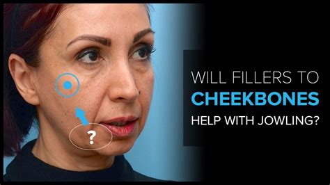 Treating Jowls With Cheek Dermal Fillers Will It Work Find Out From