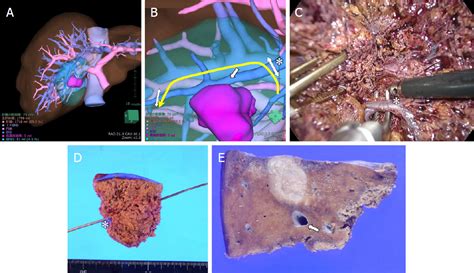 Revisiting The Role Of The Hepatic Vein In Laparoscopic Liver Resection