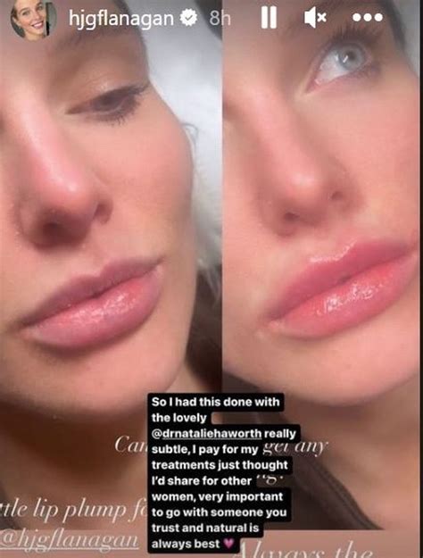Helen Flanagan Shows Off Her New Lips And Super Blonde Hair After Confidence Boosting Boob Job