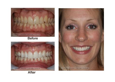 dental bonding before and after photos harley street dental group