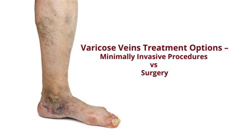 Varicose Veins Treatment Invasive Procedures Vs Surgery Drabhilash