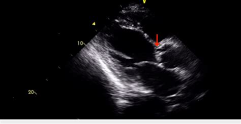 Parasternal Long Axis View Revealing The Aortic Valve Vegetation And
