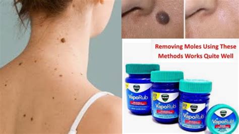 How To Remove Moles Permanently And Naturally At Home 100 Works