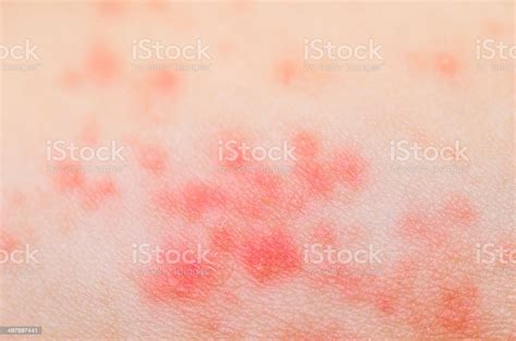 Ill Allergic Rash Dermatitis Eczema Skin Texture Stock Photo Download