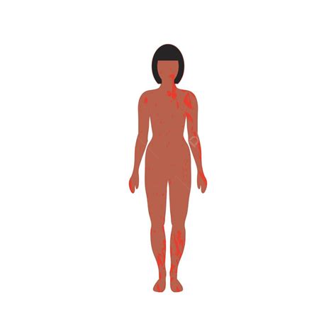 Erupção Cutânea No Corpo Feminino Bronzeado Causando Desconforto Vetor PNG Infecção Paciente