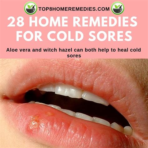 28 Home Remedies For Cold Sores Cold Sore Cold Home Remedies Cold