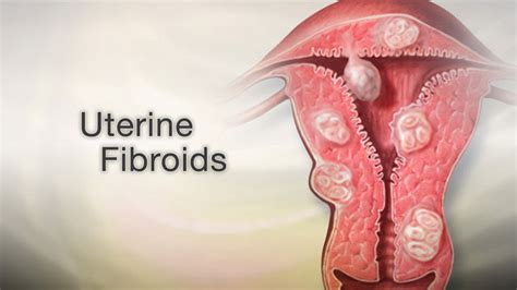 Hie Multimedia Living With Uterine Fibroids