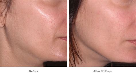 Before And After Photos Ulthera Plus