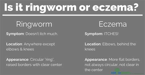 Eczema Ringworm Vs Eczema