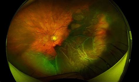 Massive Subretinal Hemorrhage Retina Image Bank