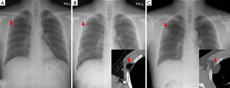 Deep Seated Intramuscular Lipoma Penetrates The Intercostal Muscle