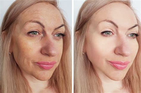 Woman Wrinkles Face Before And After Procedures Stock Photo Download