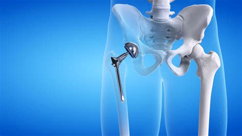 Advantages Of Getting Total Hip Replacement