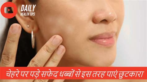 White patches on the face might be the effect of vitamin deficiency in the body. चेहरे पर पड़े सफेद धब्बों से इस तरह पाएं छुटकारा || Safed ...