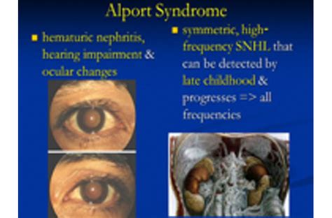 Alport Syndrome