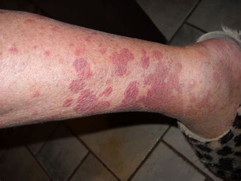 84 Yr Old Female Developed Red Blotches On Lower Legs No