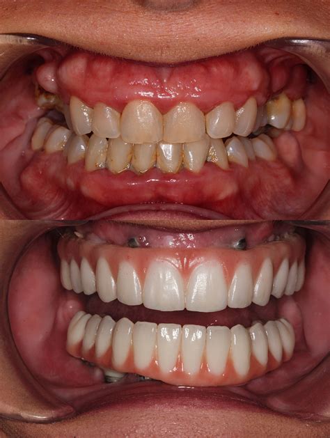 Periodontal Disease Case Study Meza Dental Care