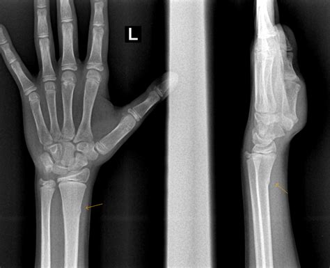 Torus Fracture Radius Sumers Radiology Blog