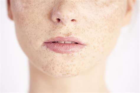 Does Having Freckles Increase Your Risk Of Skin Cancer