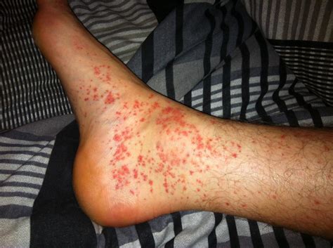 What Does A Foot Rash Mean