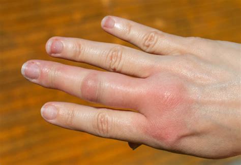 Wasp Sting Swollen Hand Stock Photos Pictures And Royalty Free Images