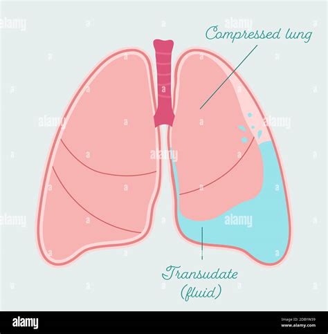 Pleural Effusion Hi Res Stock Photography And Images Alamy